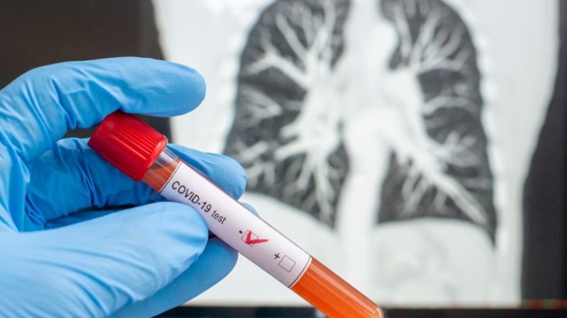 Lutte contre la COVID-19 : ARISE offre des kits  de dépistage de la maladie au COPIL!