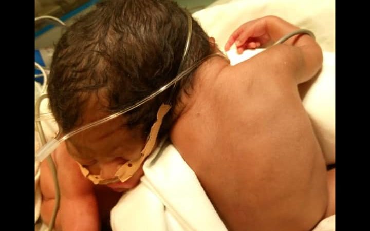 Gabon: Décès des jumelles siamoises nées à Bongolo