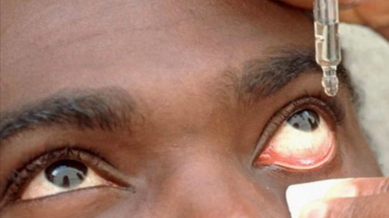 Une épidémie de conjonctivite sévit à Libreville