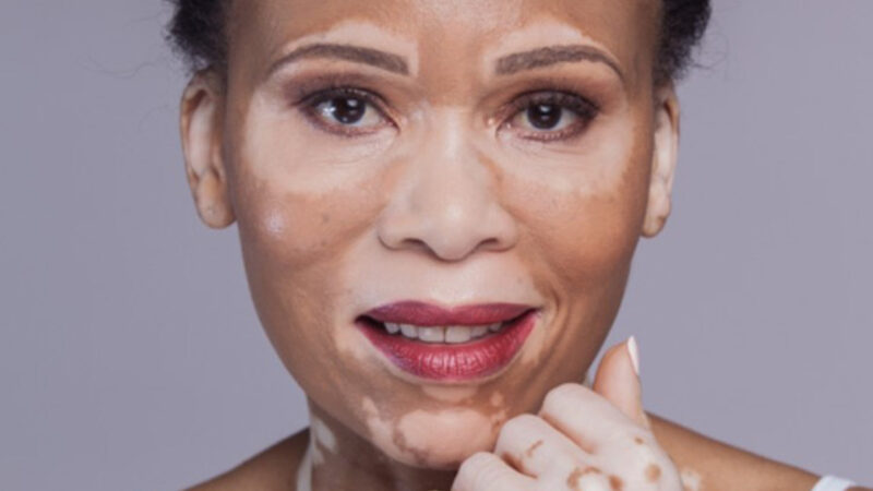 Santé/Tout connaitre sur le Vitiligo                               