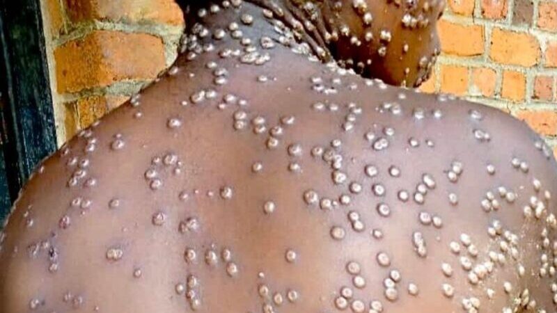Gabon : Déclaration du Premier Cas de Mpox – Ce Qu&rsquo;il Faut Savoir